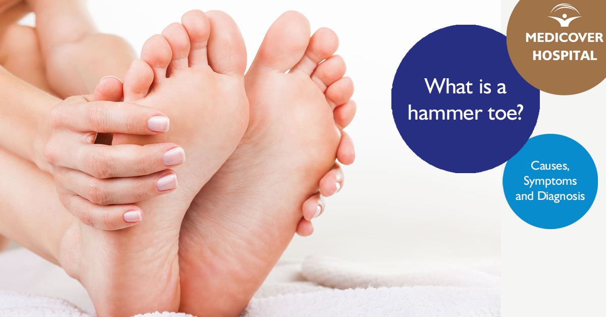 MKorhaz_FB_1200x628_hammer-toe-180424