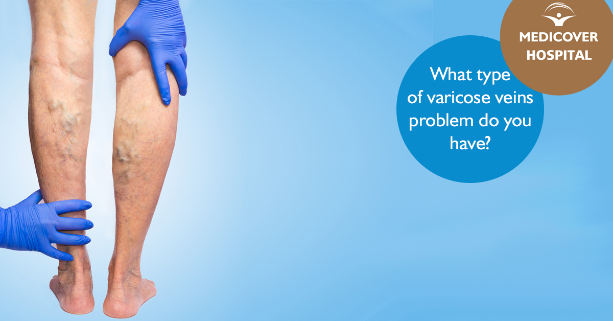 MKorhaz_FB_1200x628_what-type-varicose-180719